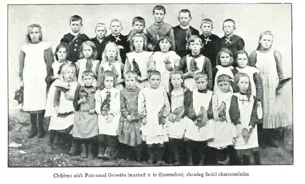 A photo of a class of children. Text at the bottom reads "Children with post-nasal growths (Marked X in illustration), showing facial characteristics."
